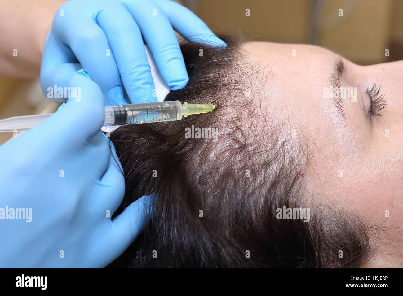 Anti hair loss injection in clinic Stock Photo