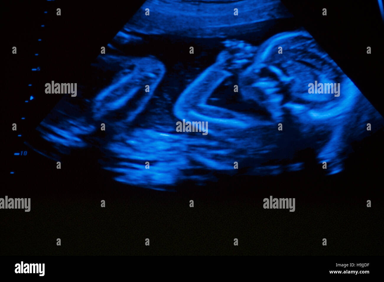 20 week ultrasound scan of pregnant Stock Photo - Alamy