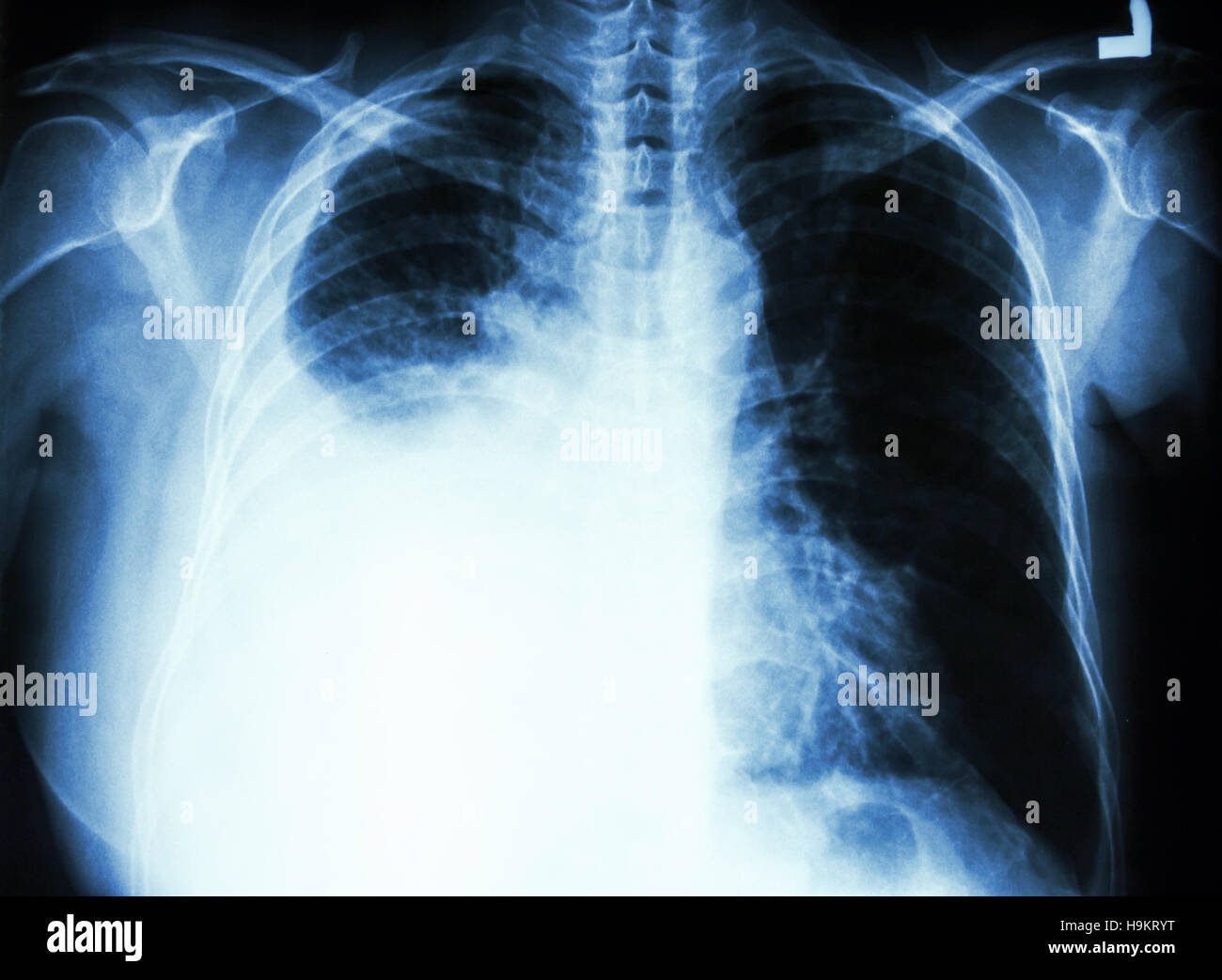 film chest X-ray PA upright : show pleural effusion at right lung due to lung cancer Stock Photo