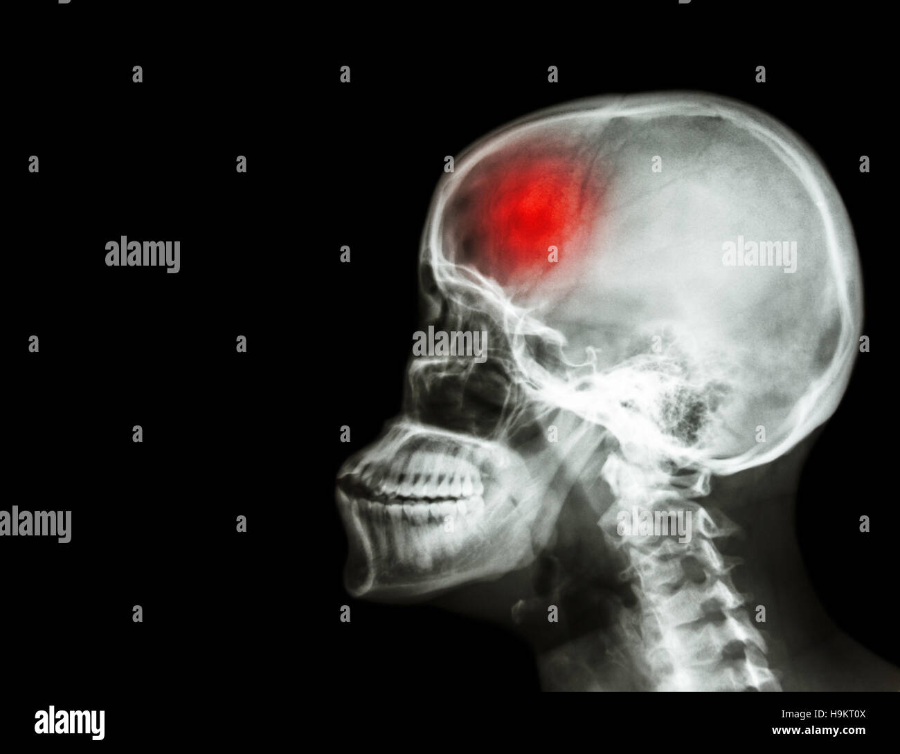 Stroke . film x-ray skull and cervical spine lateral view and stroke . cerebrovascular accident . blank area at left side . Stock Photo