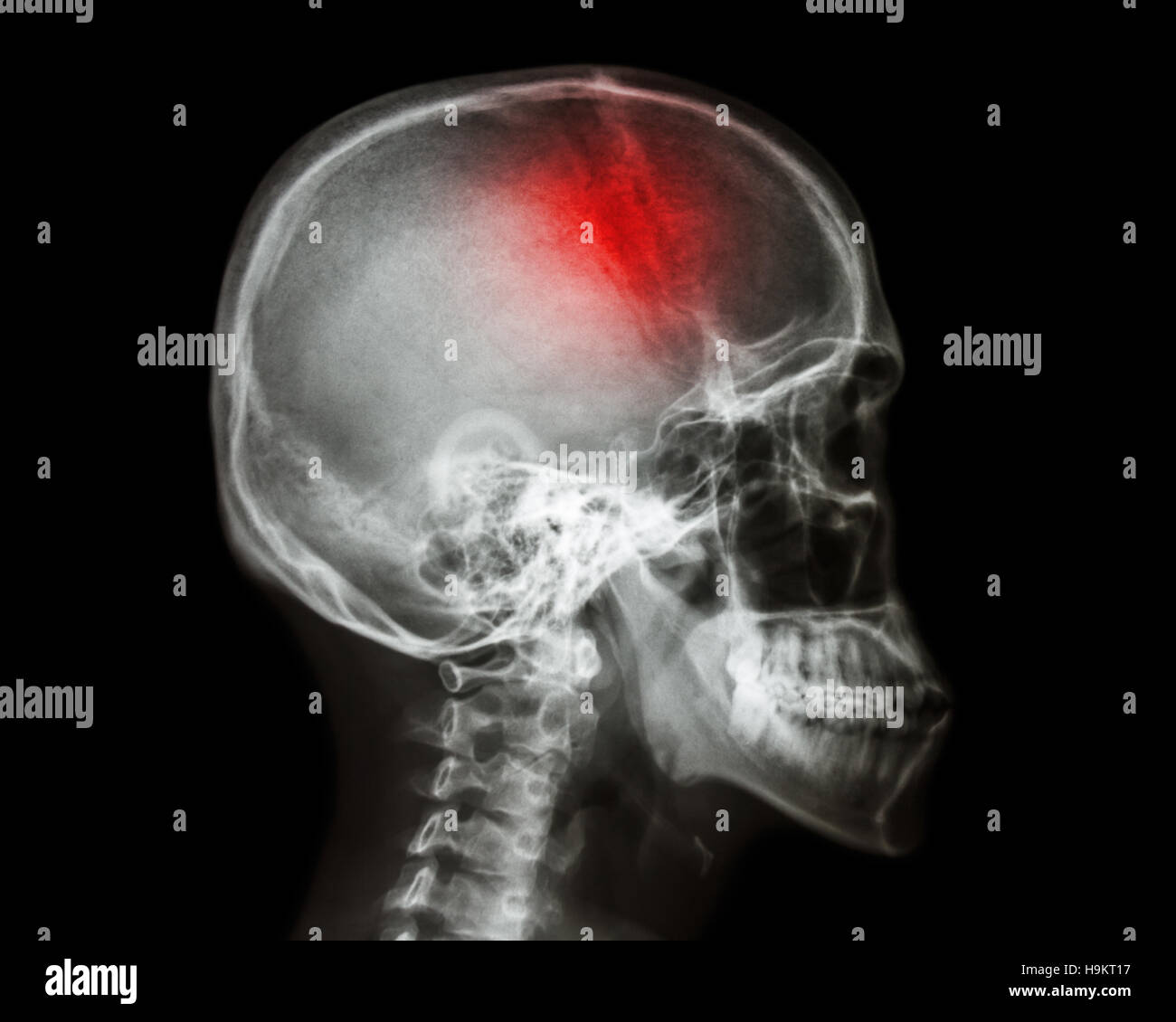 Stroke . film x-ray skull lateral view show human skull and stroke . cerebrovascular accident . isolated background Stock Photo