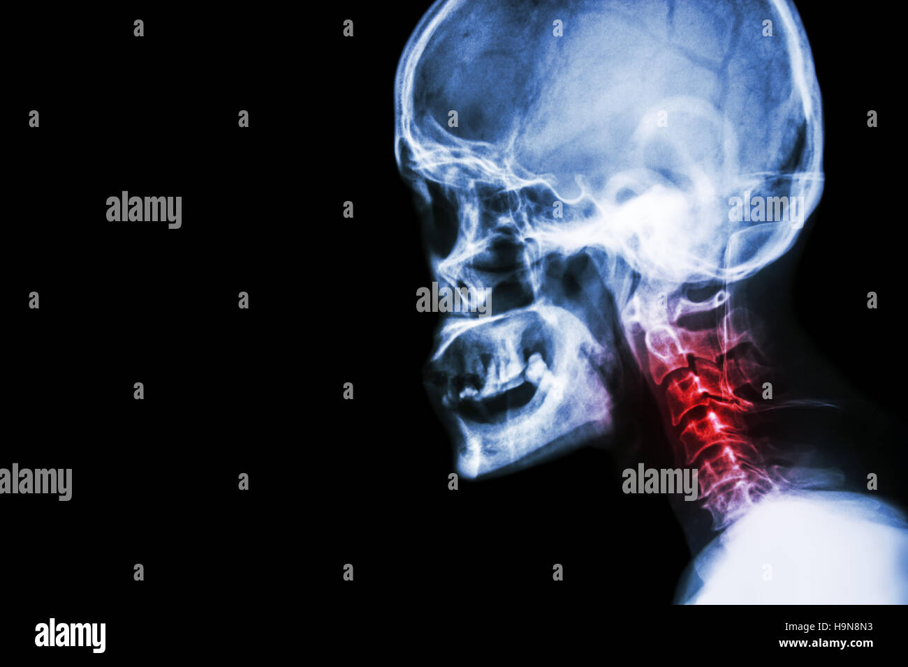 Cervical spondylosis . film x-ray skull lateral view and neck pain . Stock Photo