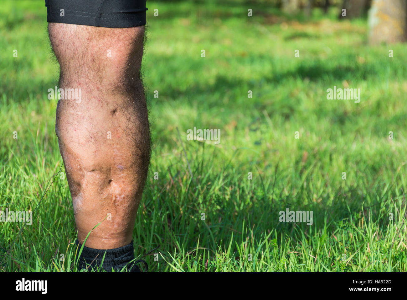 Old scar of leg injury, from car or motorbike accident, deep tissue scar , hairless man leg, calf injury , large scar on right hand calf. The scars as Stock Photo