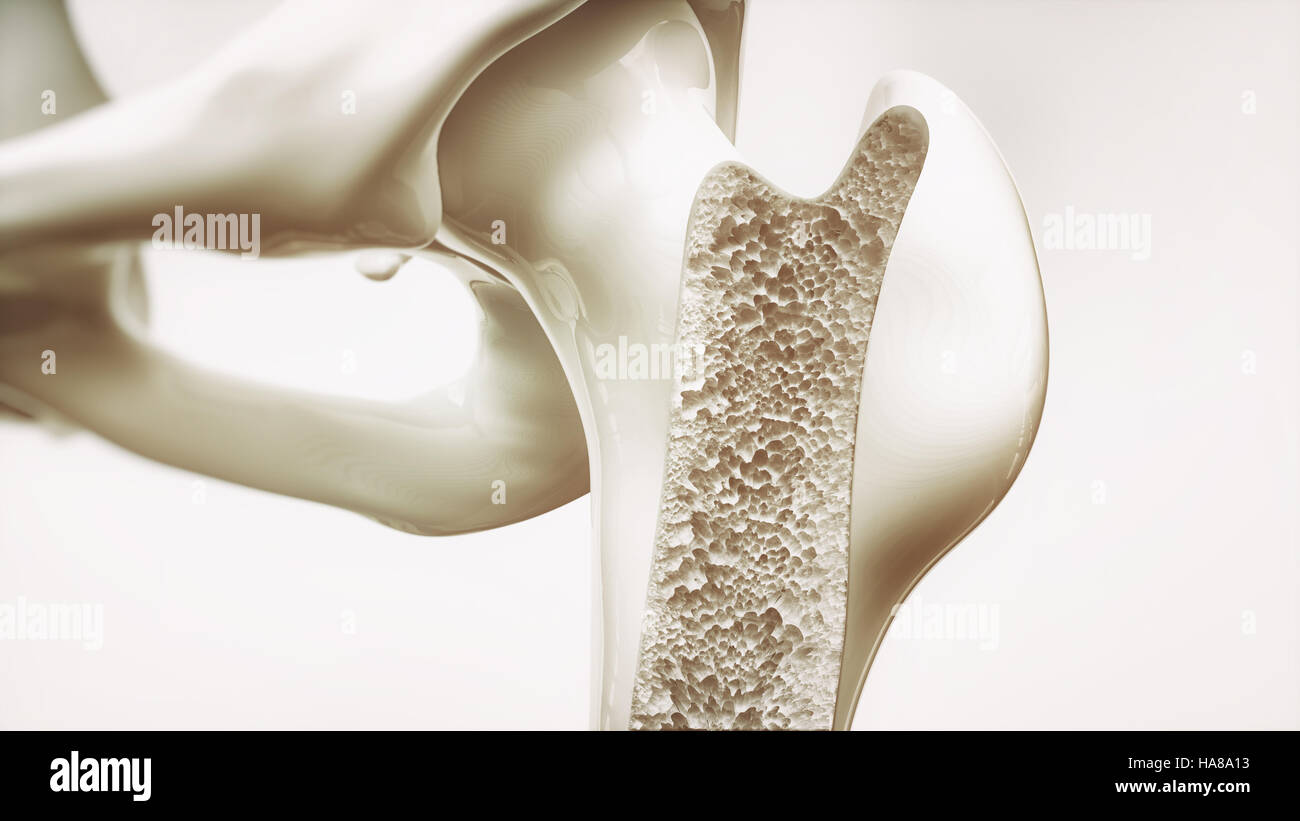 Osteoporosis stage 3 of 4 - upper limb bones - 3d rendering Stock Photo ...