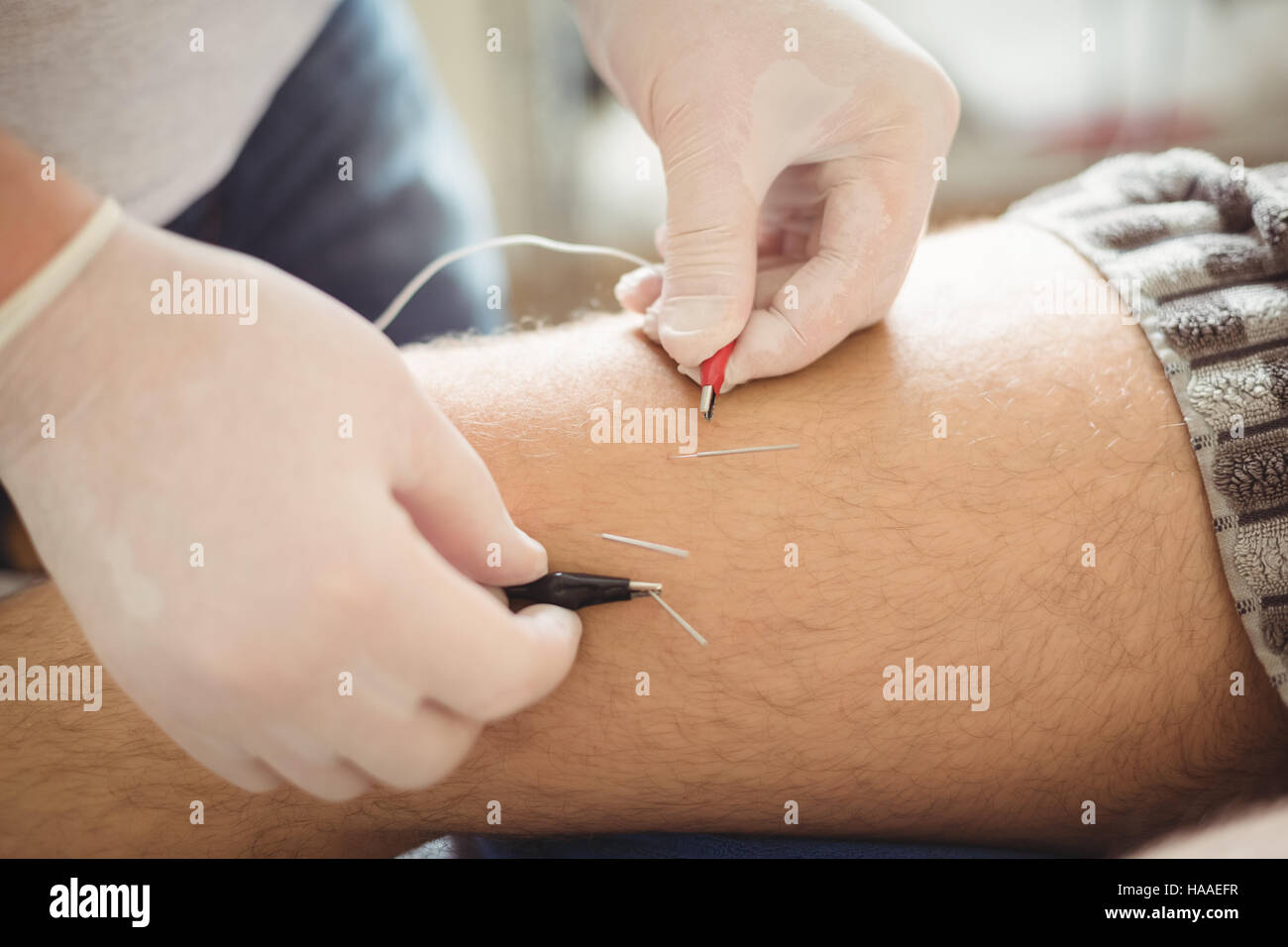 Electroacupuncture dry with needle on female ankle.. Electroacupuncture dry  with needle connecting machine used by acupunturist on female patient for  acupuncture guided by EPI Intratissue Percutaneous Electrolisis. Electro  stimulation in physical therapy