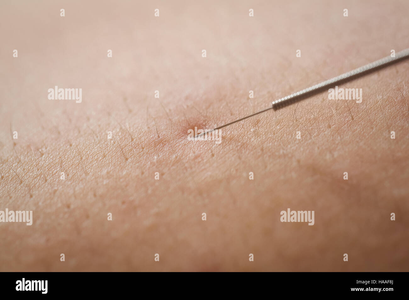 Muscle spasm close up hires stock photography and images Alamy