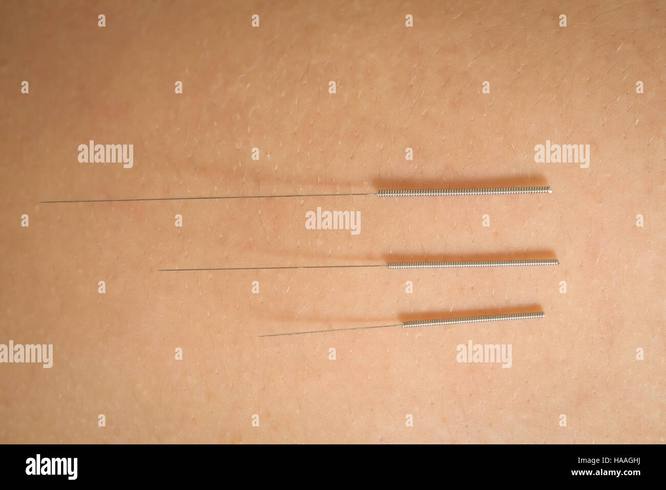 Closeup of needles for dry needling on skin Stock Photo Alamy
