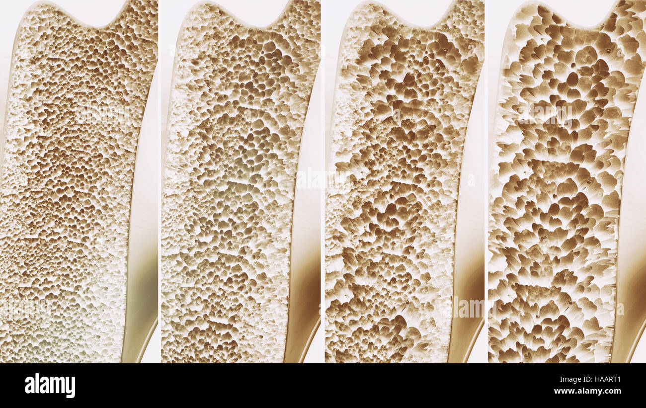 Osteoporosis 4 stages - 3d rendering Stock Photo