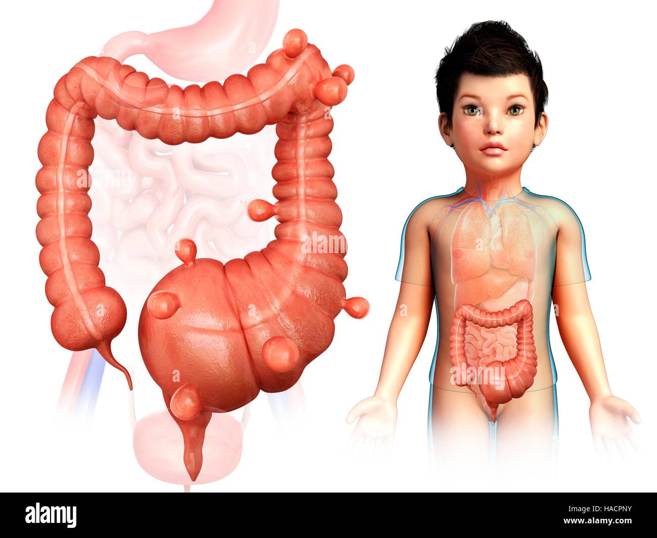 Мегаколон ирригоскопия. Для идиопатического мегаколон характерно. Болезнь гиршпрунга рентгенограмма. Для идиопатического мегаколон характерно. Радиомед клинические наблюдения.