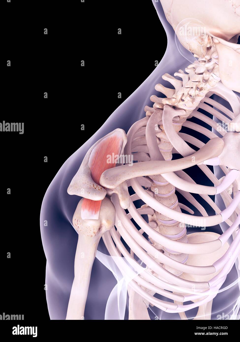 Retraction Of Supraspinatus Tendon