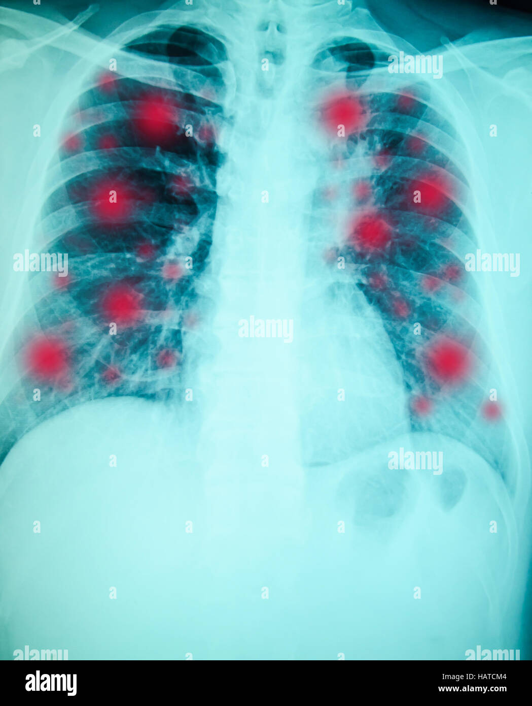 chest xray examination for diagnosis with red dot inflammatory Stock Photo Alamy