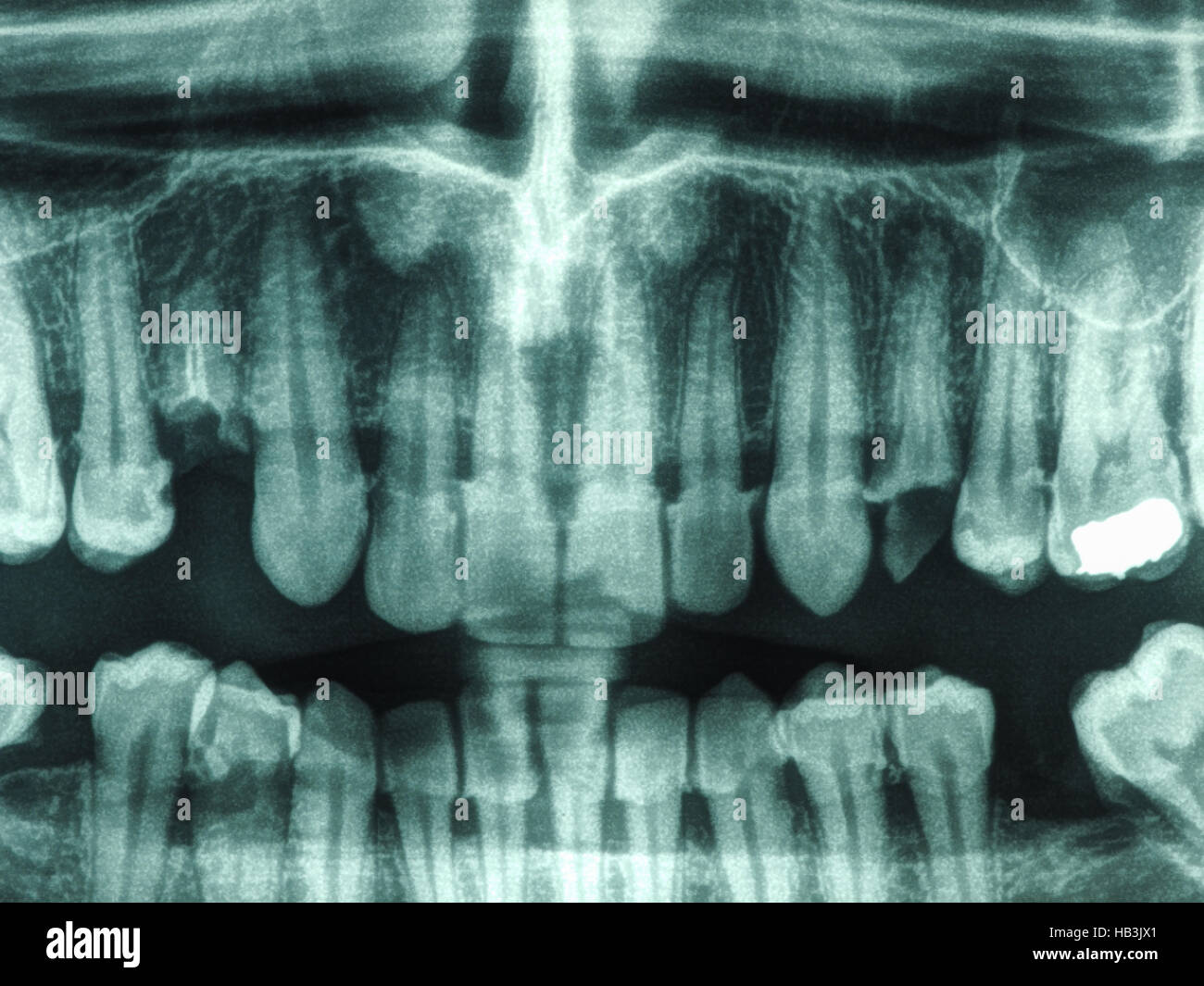 Teeth xray hi-res stock photography and images - Alamy