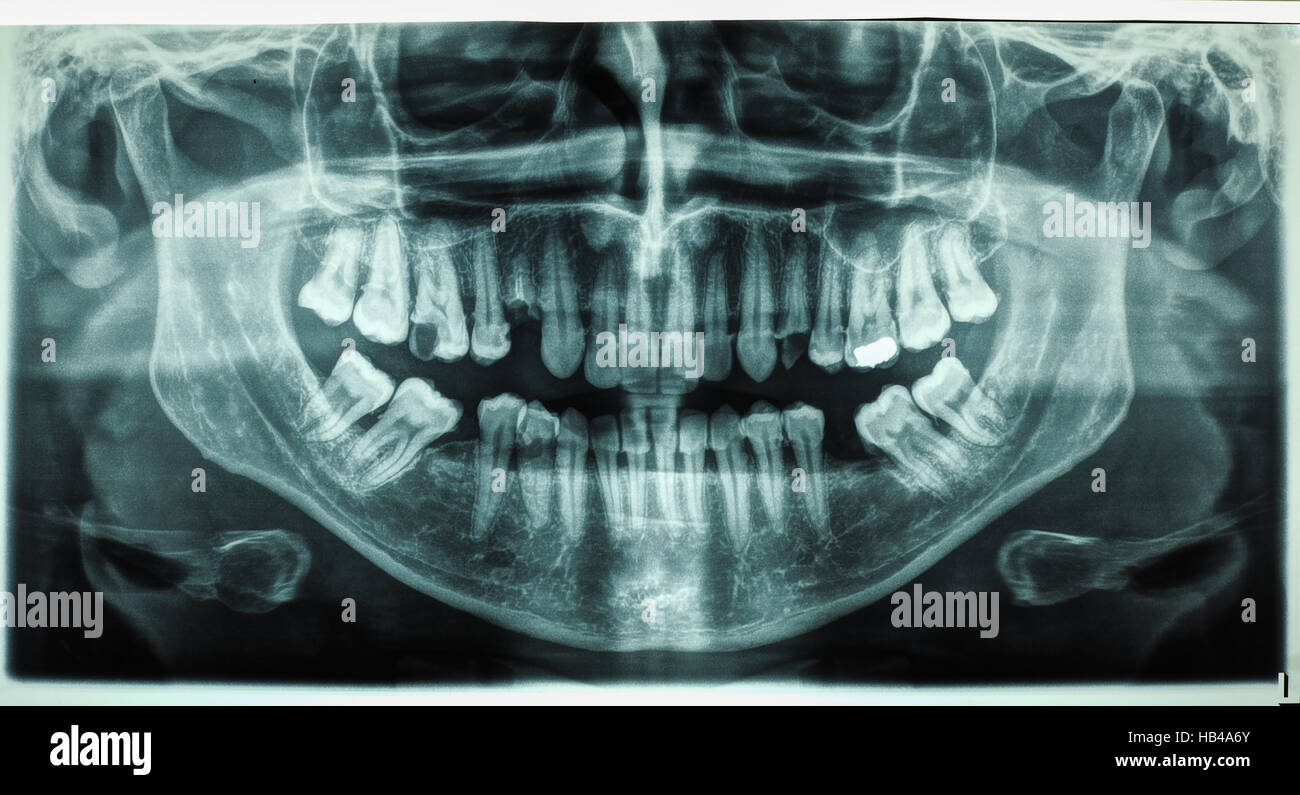 Human teeth xray Stock Photo Alamy