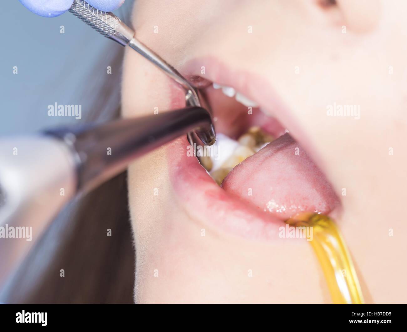 Dentist filling woman's teeth with composite material. Stock Photo