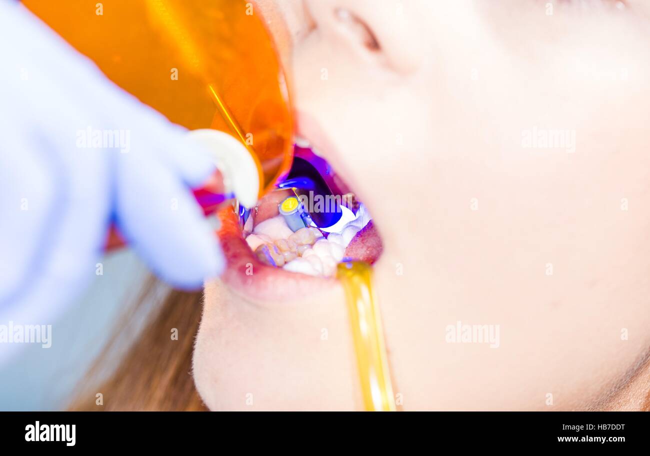 Dentist filling woman's teeth with composite material. Stock Photo