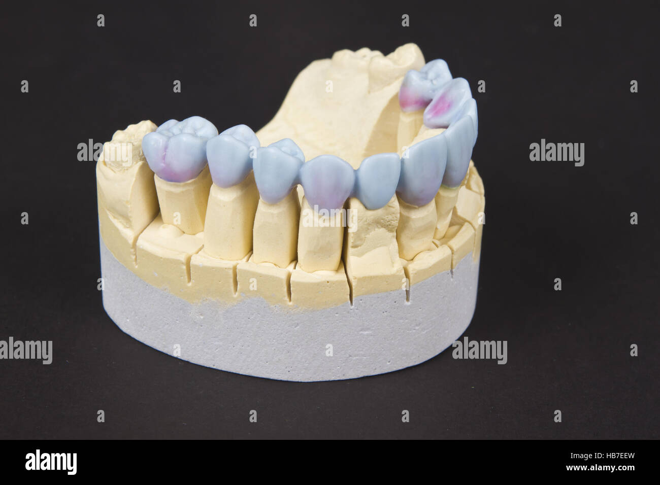 closeup for a mock up of a dental circular bridge Stock Photo