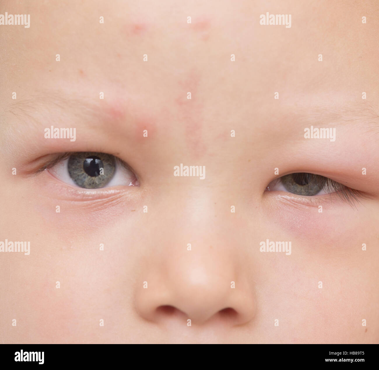 Mosquito Bite On Forehead