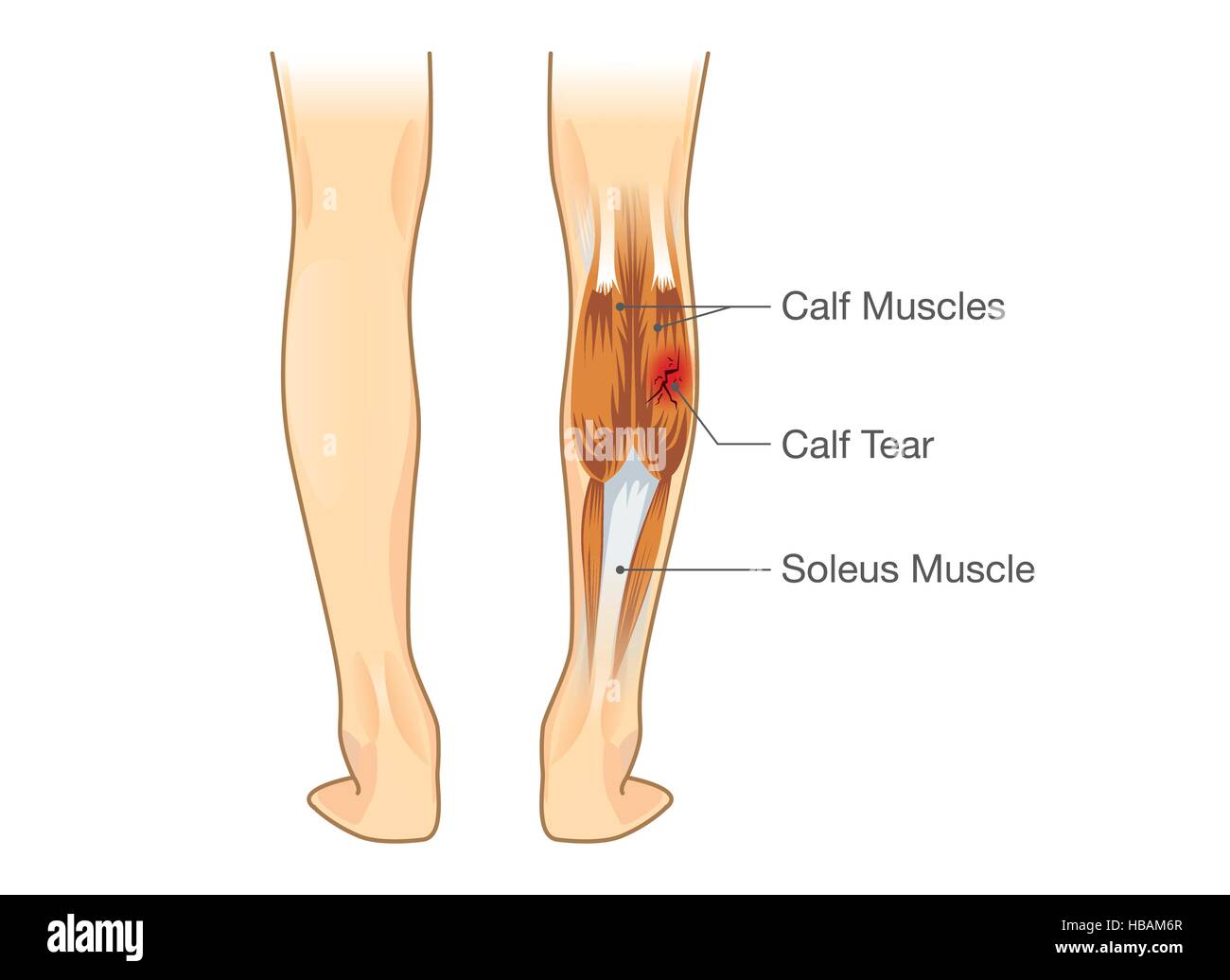 Calf muscle tear Stock Vector Image & Art - Alamy