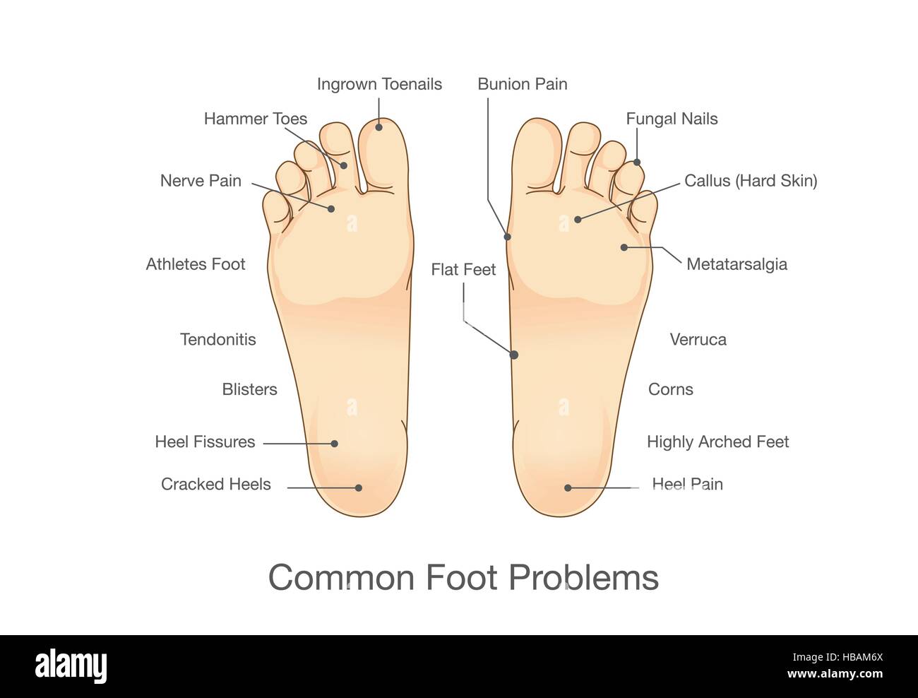 Common foot problems. Stock Vector