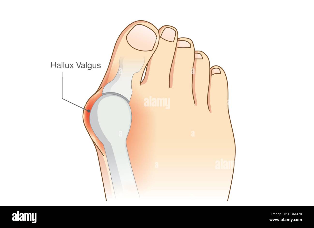 Abnormal of foot shape from deformity joint toe. Stock Vector