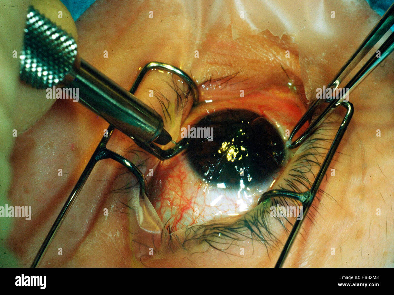 Eye surgery, Radial Keratotomy eye operation to correct short sight, 1985 Stock Photo