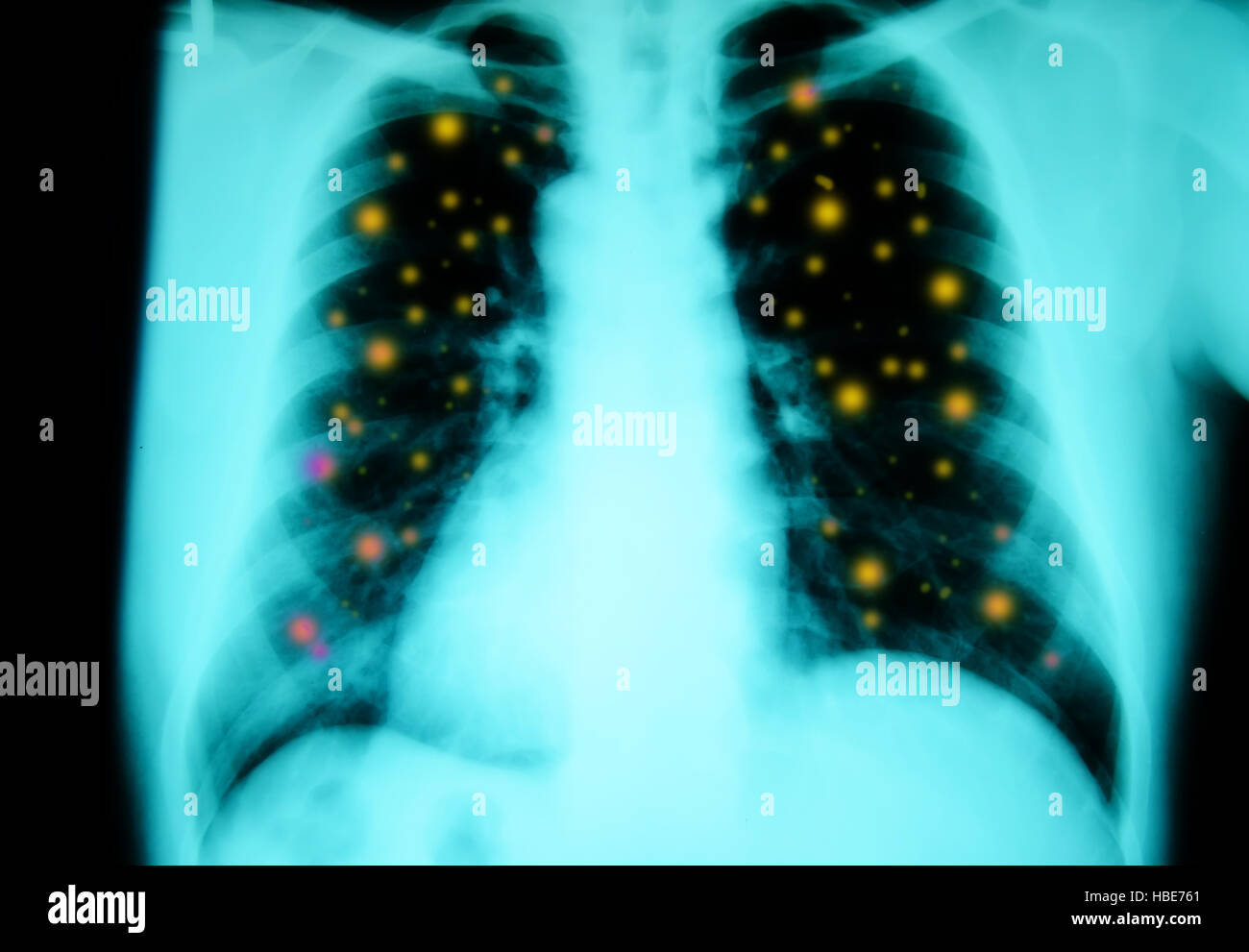 chest xray examination for diagnosis with yellow dot inflammatory