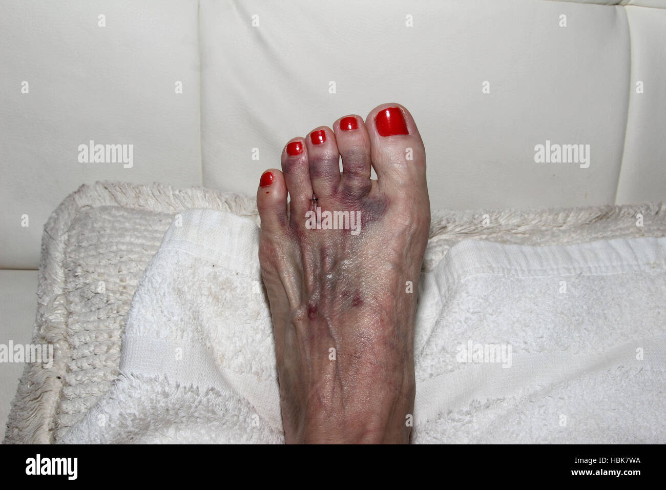 Foot after Morton’s neuroma surgery Stock Photo