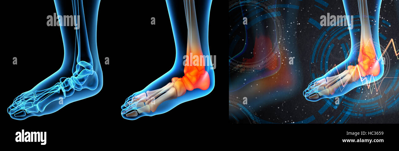 3d render illustration of the ankle pain Stock Photo - Alamy