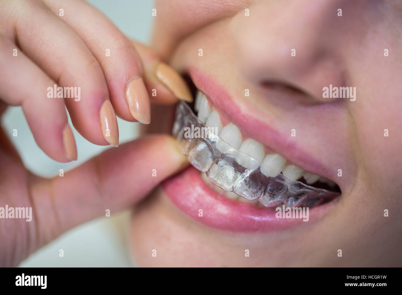 Woman wearing orthodontic silicone invisible braces Stock Photo