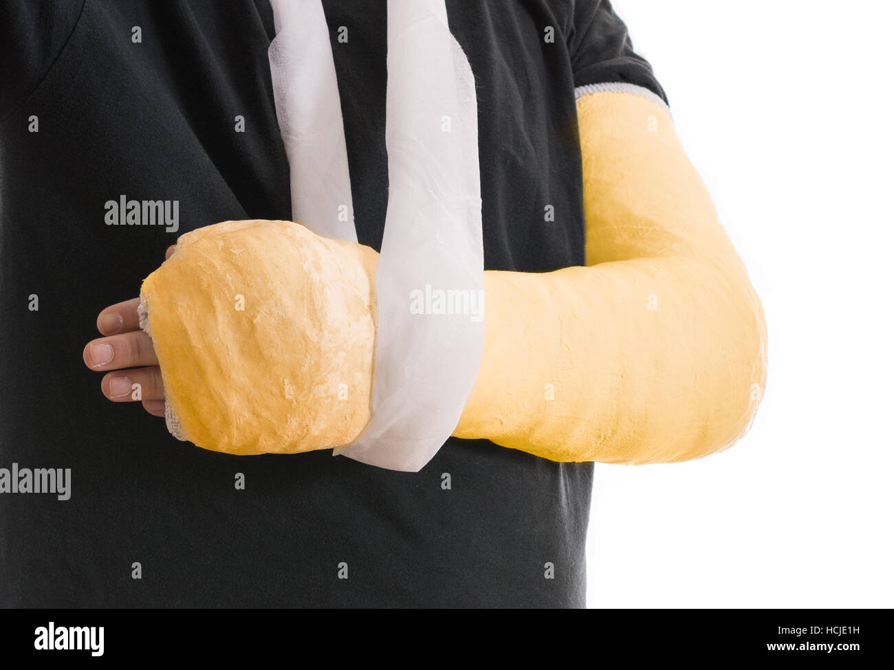 Arm cast bright yellow long arm cast in a sling for a broken elbow, arm, or wrist. Arm covered