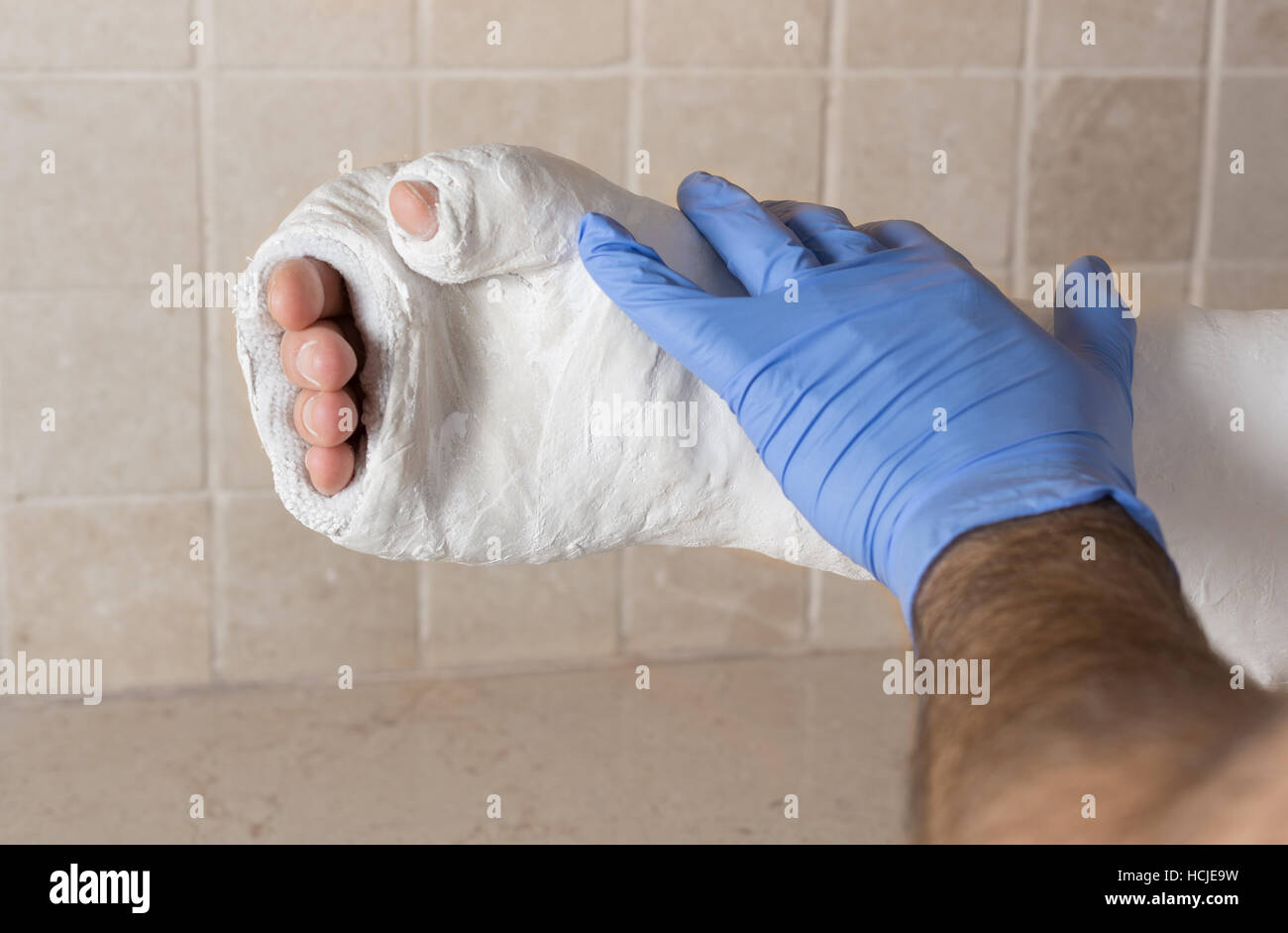 Orthopedic technician putting on a fiberglass / plaster cast on a young man's broken and fractured arm after an injury.  Close up image shows the cast Stock Photo