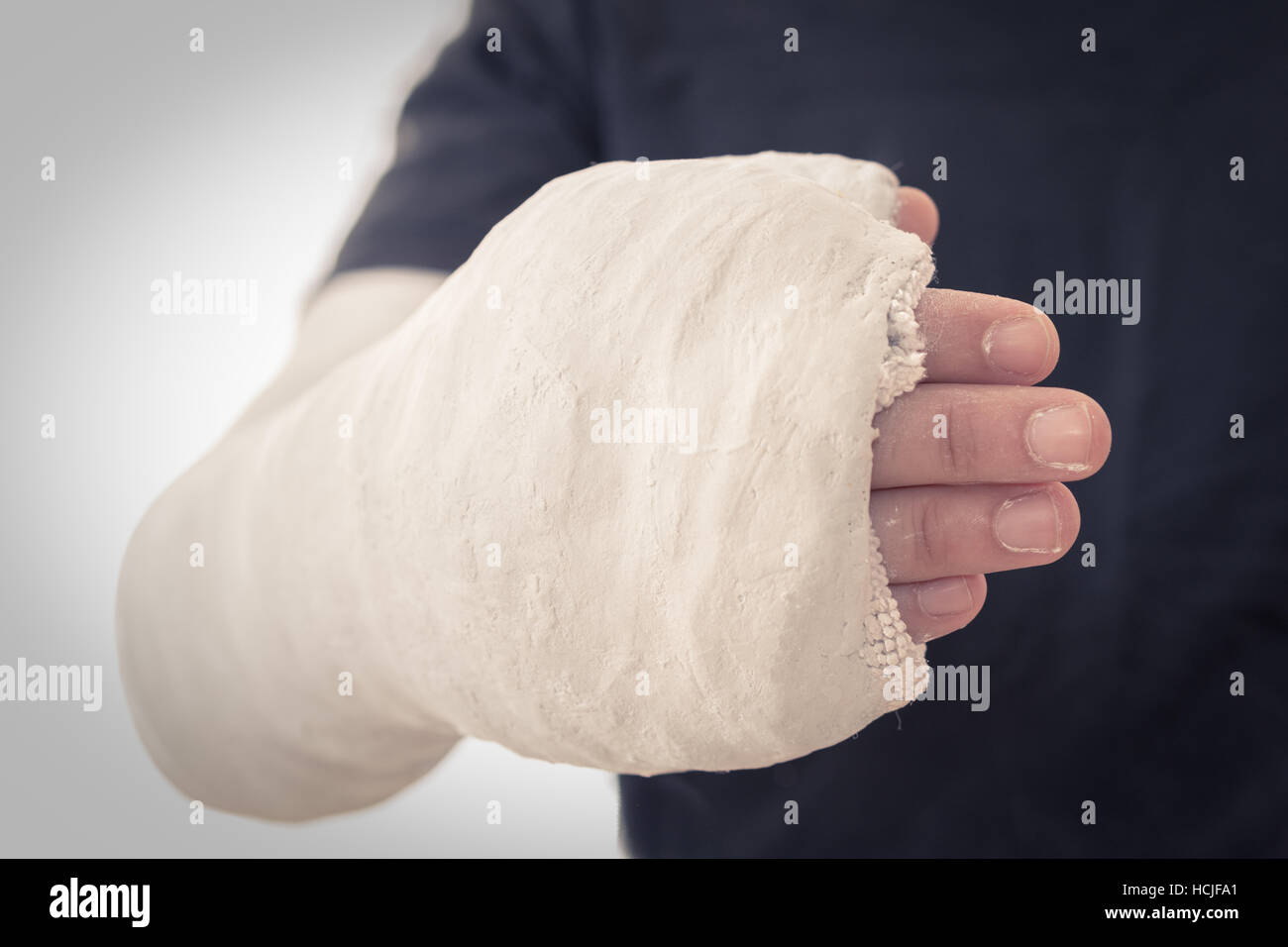 Long Arm Thumb Spica Cast