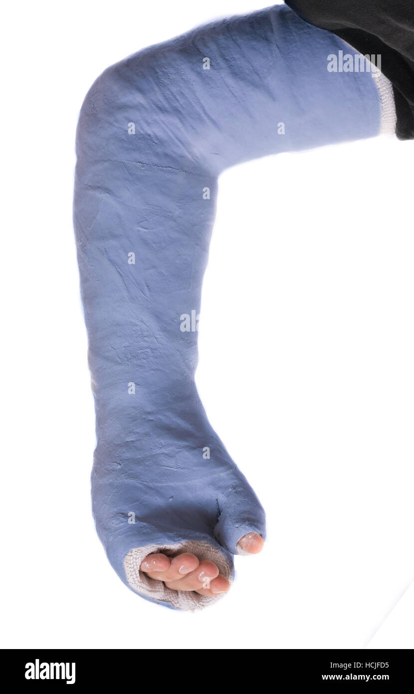 Close up of a young man's blue long arm plaster / fiberglass cast covering the wrist, arm, and elbow after an accident, isolated on white Stock Photo