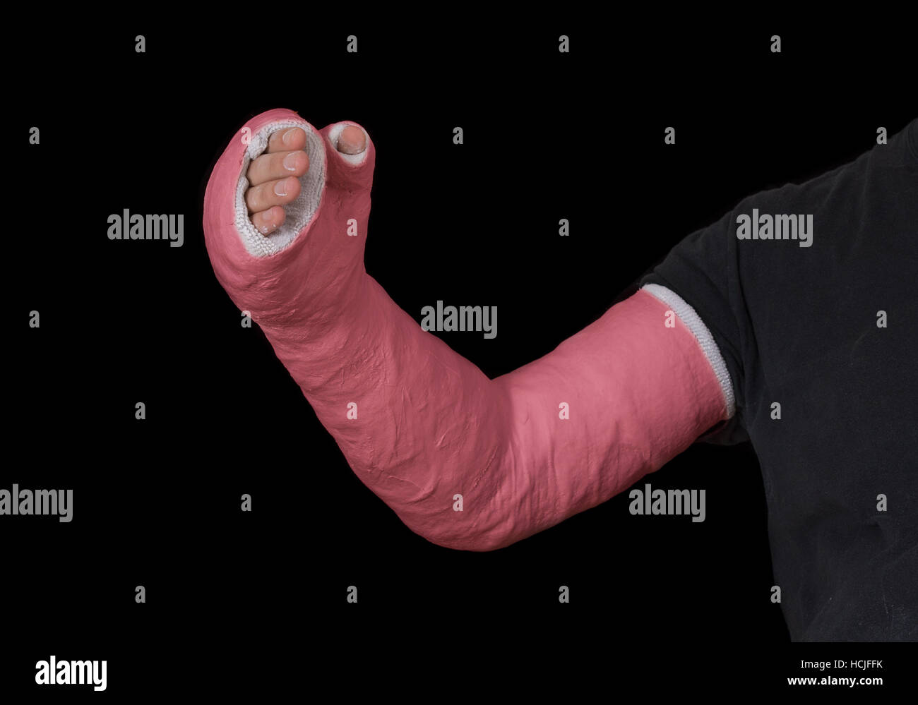 Close up of a red long arm plaster / fiberglass cast covering the wrist