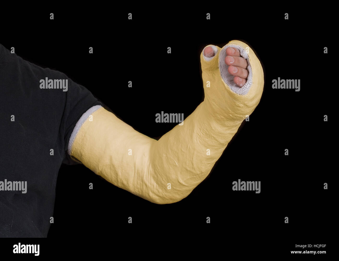 Close up of a yellow long arm plaster / fiberglass cast covering the