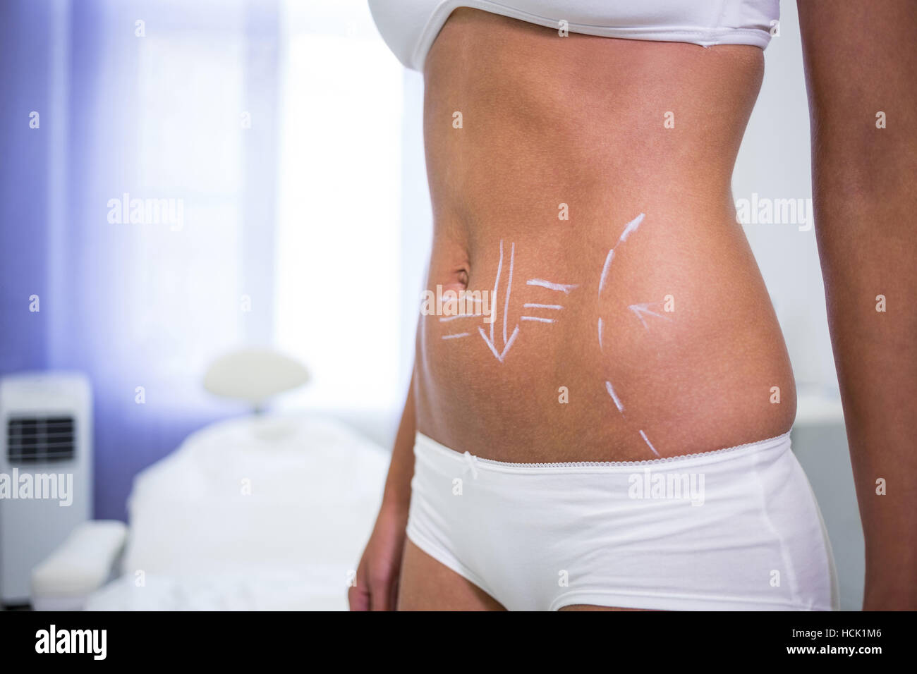 Female body with the drawing arrows for abdomen for liposuction and cellulite removal Stock Photo