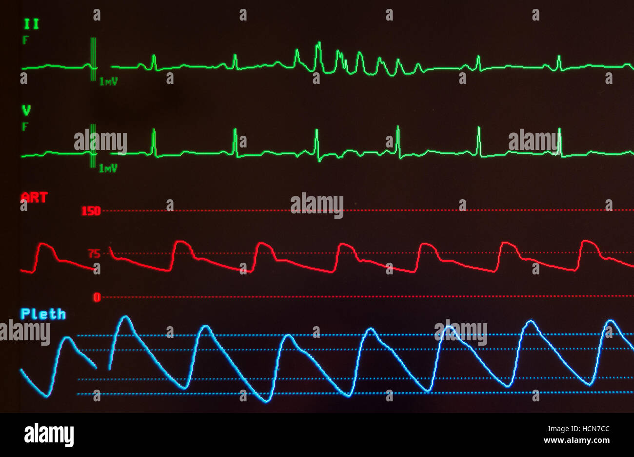 Close up of medical monitor with ECG with ventricular tachycardia, arterial blood pressure wave and oxygen saturation level. Stock Photo