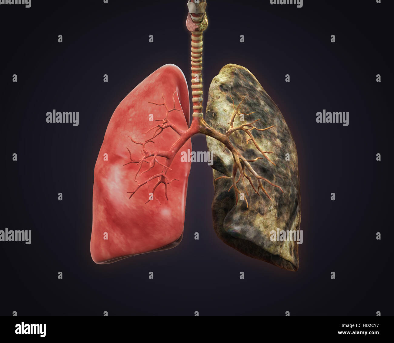 Healthy Lung and Smokers Lung Stock Photo