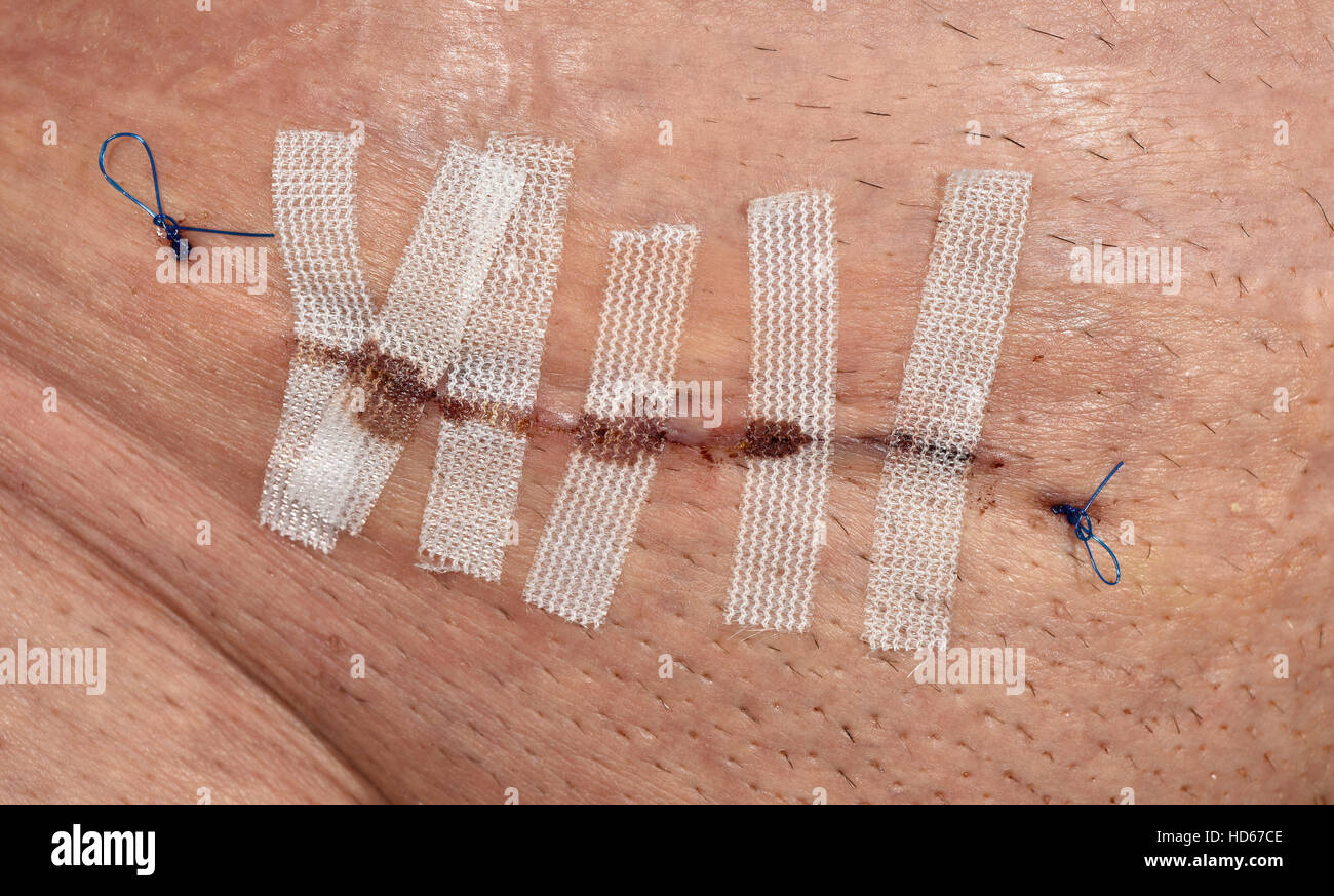 Stitched wound suture with filaments and Steristrips after hernia surgery Stock Photo