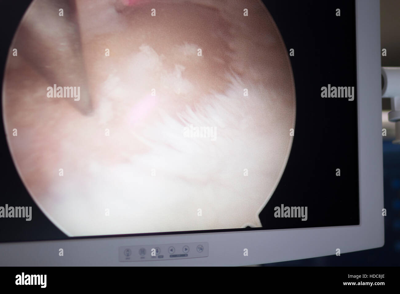 Arthroscopy surgery screen showing arthroscope camera picture in knee