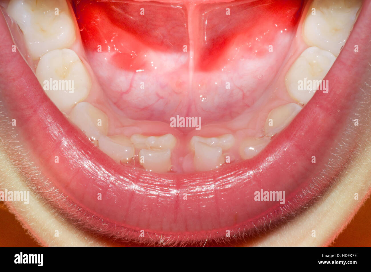 child's mouth with baby teeth and grown up teeth both on bottom incisors this is known as shark teeth Stock Photo