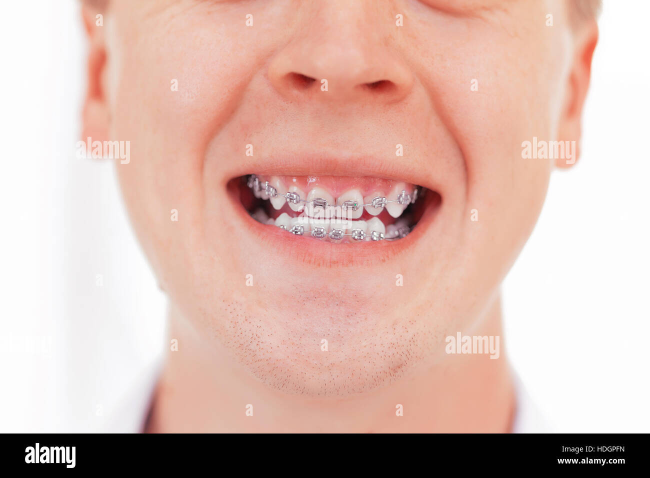 Ugly Teeth Stock Photos & Ugly Teeth Stock Images Alamy