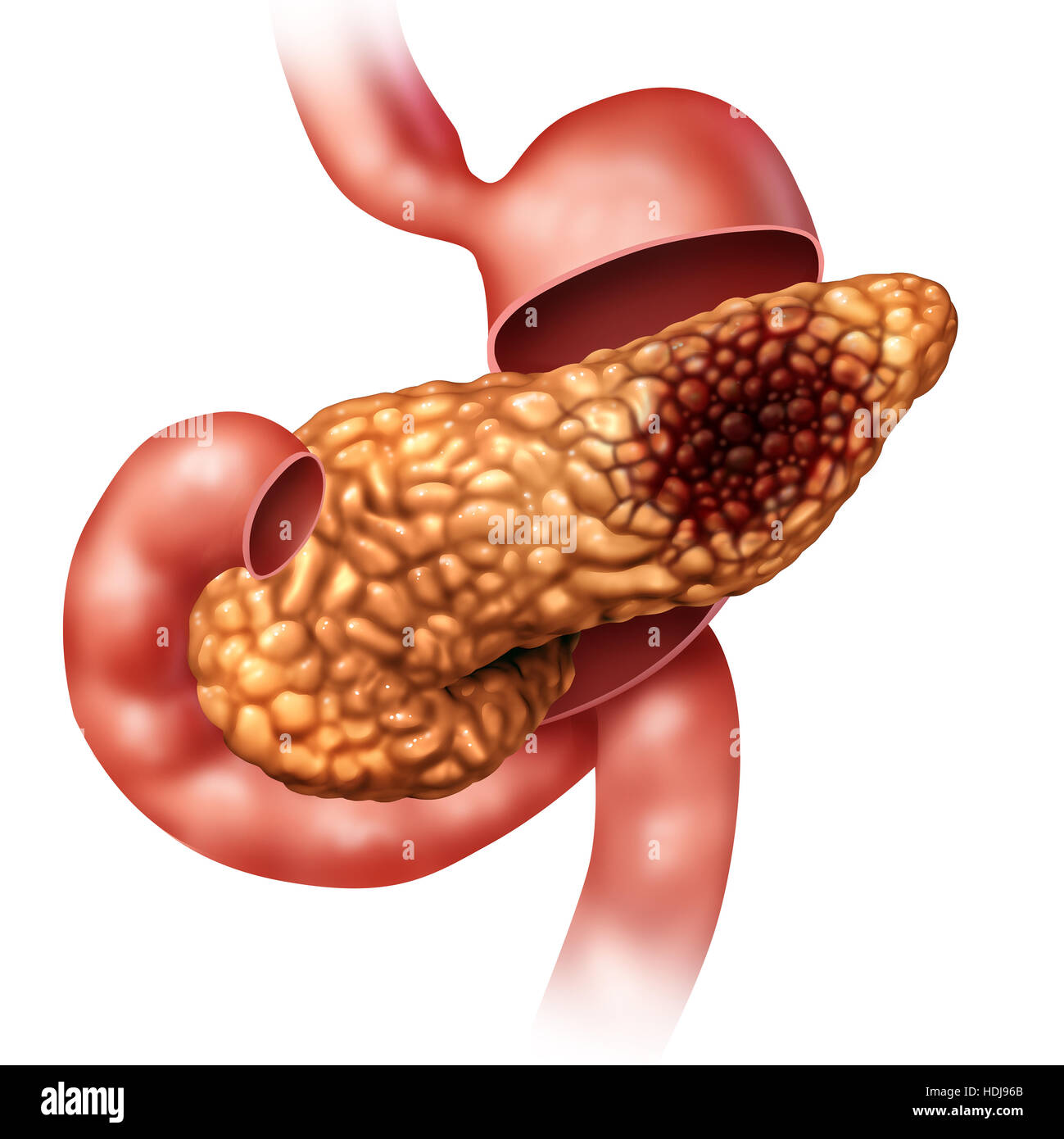 Pancreatic cancer concept and Pancreas malignant tumor symbol as a digestive gland body part with stomach cross section with a malignant tumor growth Stock Photo