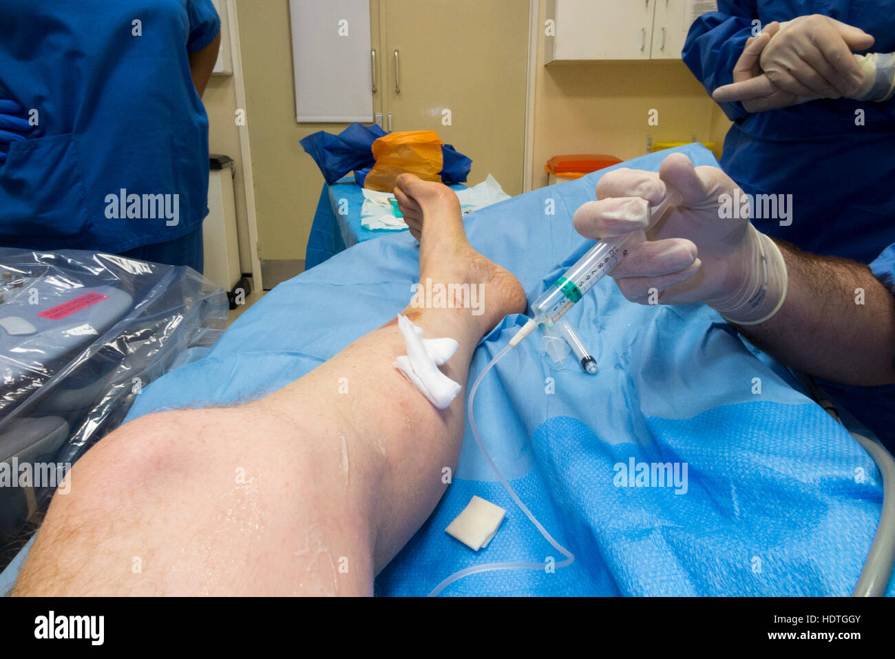 Foam sclerotherapy procedure involving ultrasound & injection