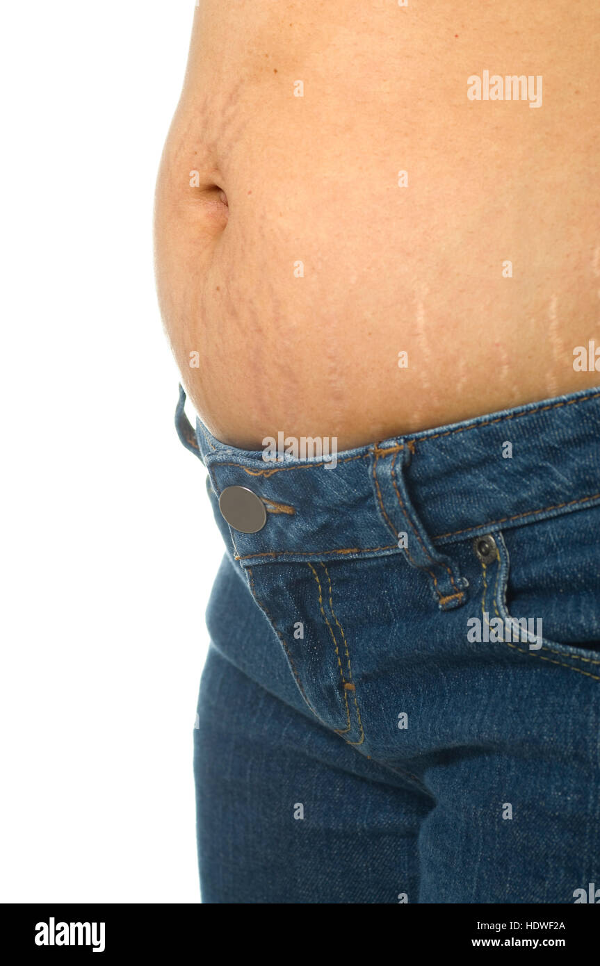 Stretch mark on mature woman stomach wearing blue jeans Stock Photo