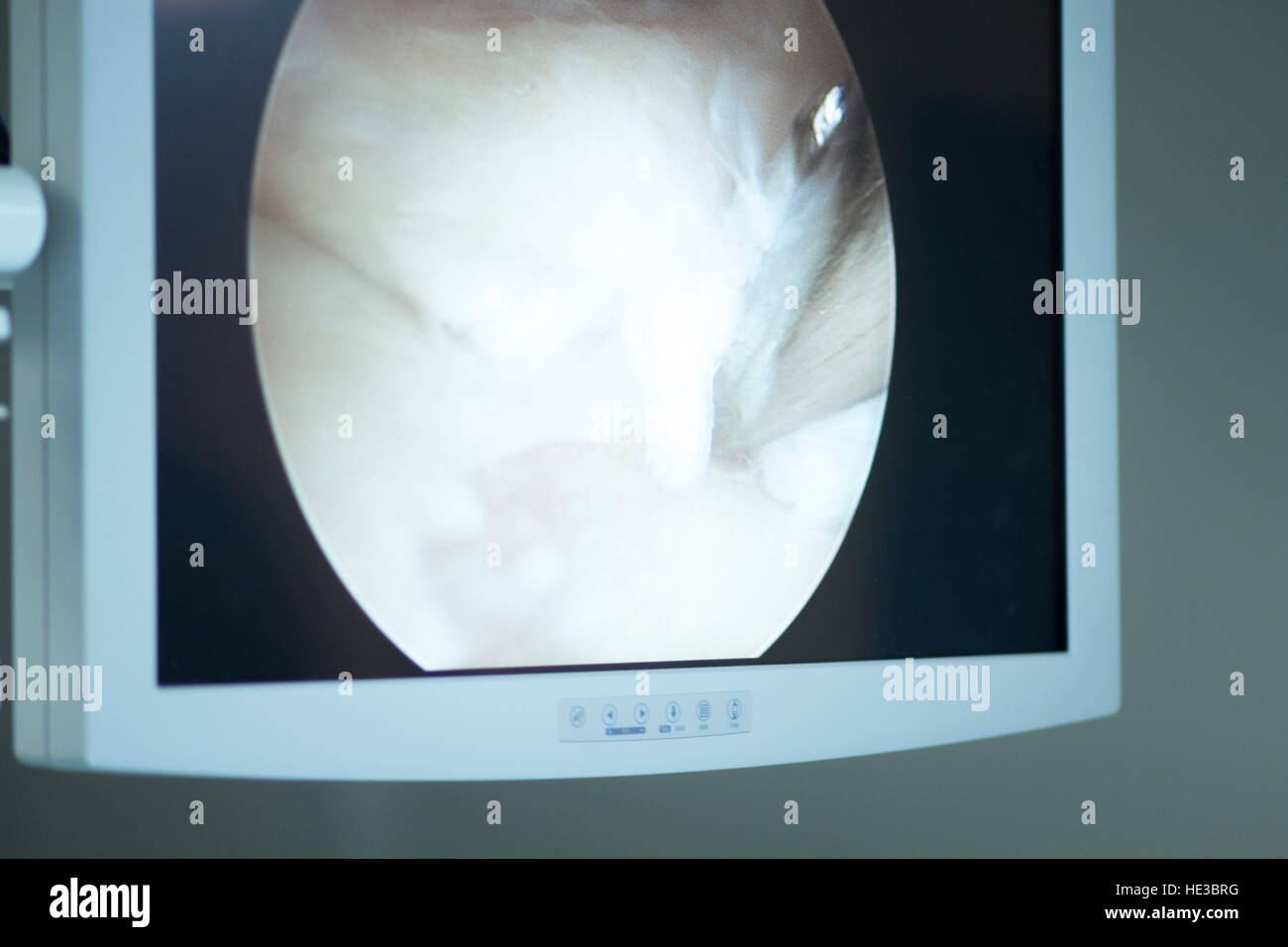 Arthroscopy surgery screen showing arthroscope camera picture in knee