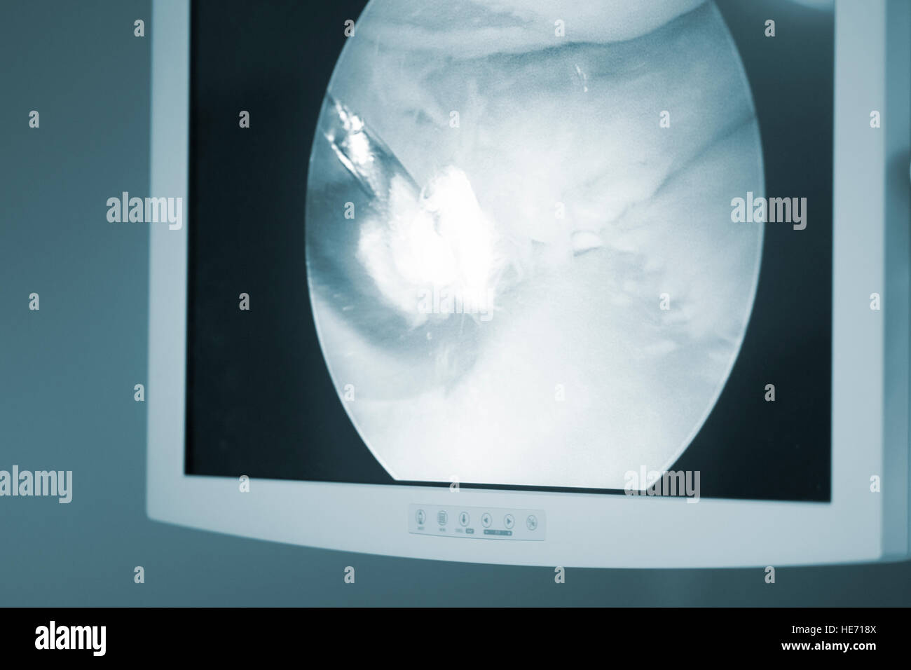 Arthroscopy surgery screen showing arthroscope camera picture in knee