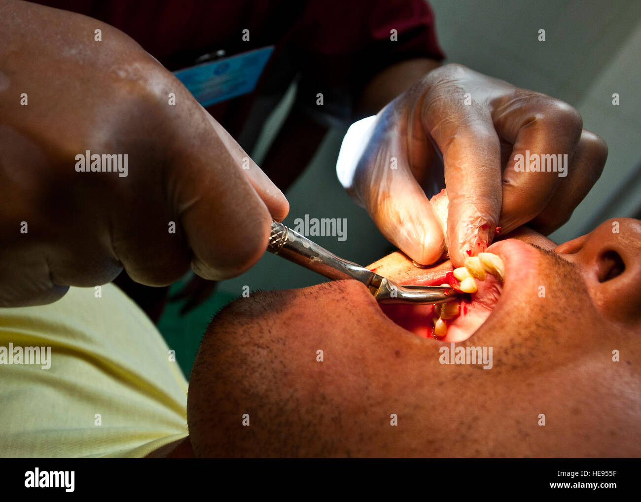 Kyrgyz Republic Lt. Aibek Mamadiyarov conducts an oral extraction procedure on a patient during a dental exchange at the Besh Kungei Trauma Center, Kyrgyzstan, Aug. 16, 2012. The dental procedures practiced during the exchange consisted of oral assessments, cleanings and extractions. Senior Airman Brett Clashman) Stock Photo