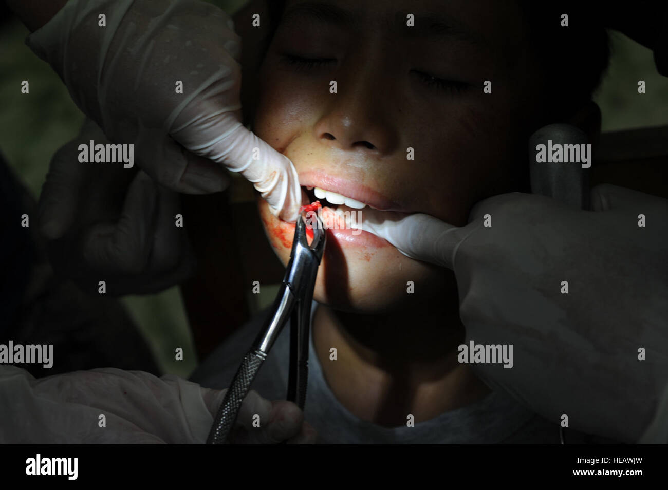 Delgerkhaan, Mongolia – A tooth is prepped for pulling from a young Mongolian boy by U.S. Air Force Staff Sgt. Jose Cardenas, a native of Hildalgo, Texas and currently assigned to the 8th Medical Group, Kunsan Air Base, Republic of Korea and Major (Dr.) Rebecca Neitzke, a native of Grand Rapids Minn., and currently assigned to Kunsan AB, ROK, while at the two-day multinational mobile clinic in Delgerkhaan, Mongolia on July 20 in support of Pacific Angel-Mongolia, a 13th Air Force led combined humanitarian assistance operation. U.S. Soldiers, Sailors and Airmen worked together with Mongolian Ar Stock Photo