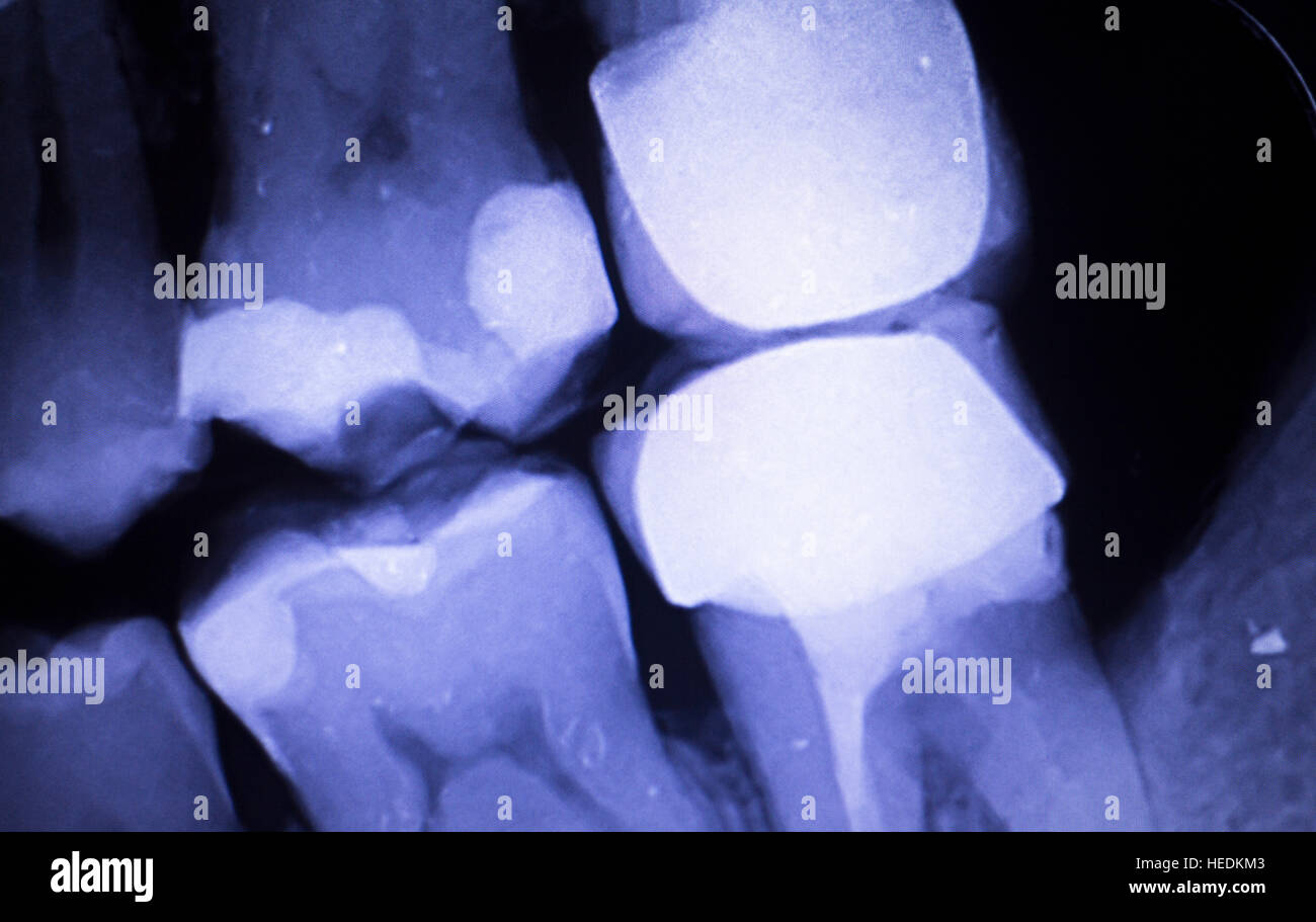 Tooth with filling dental xray closeup image showing teeth roots, gum